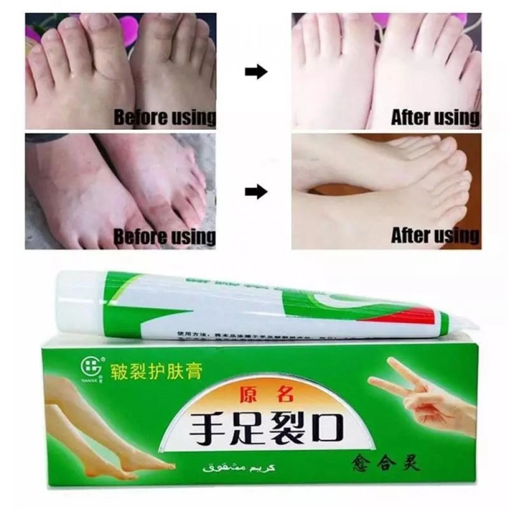 Cream obat kaki pecah dan tumit kering