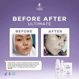 Nbs Skincare Paket Ultimate 10g